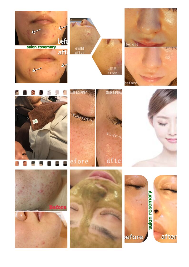 ハーブピーリング施術 before after 症例写真